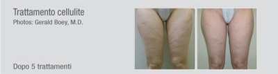 Trattamento Cellulite